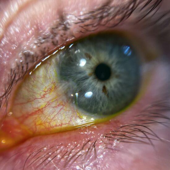 PTERIGIUM